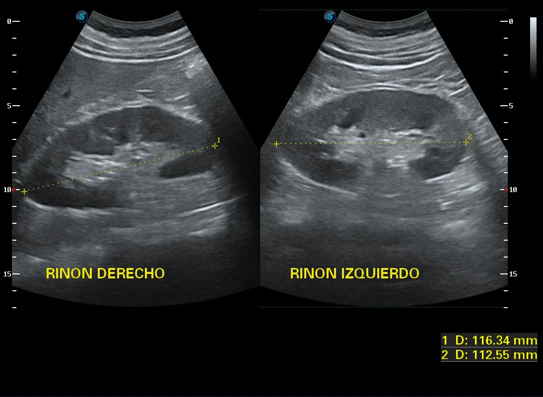 Ultrasonido de ambos riñones en un mismo estudio · imagen clínica anonimizada
