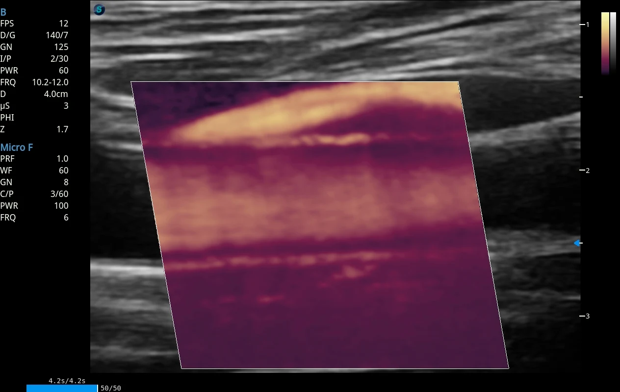 Imagen clínica anonimizada de arteria carótida evaluada con microflujo Doppler