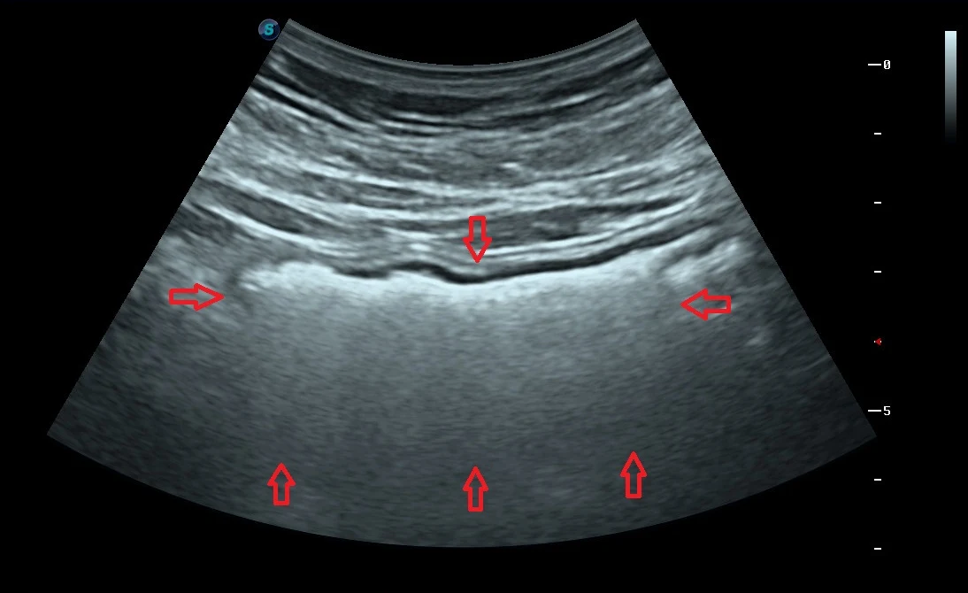 Colon con abundante gas intestinal señalado en ultrasonido · imagen clínica anonimizada