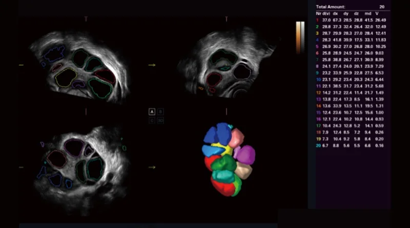 Conteo de 20 folículos mediante ultrasonido 3D volumétrico con reconstrucción multicolor · imagen clínica anonimizada