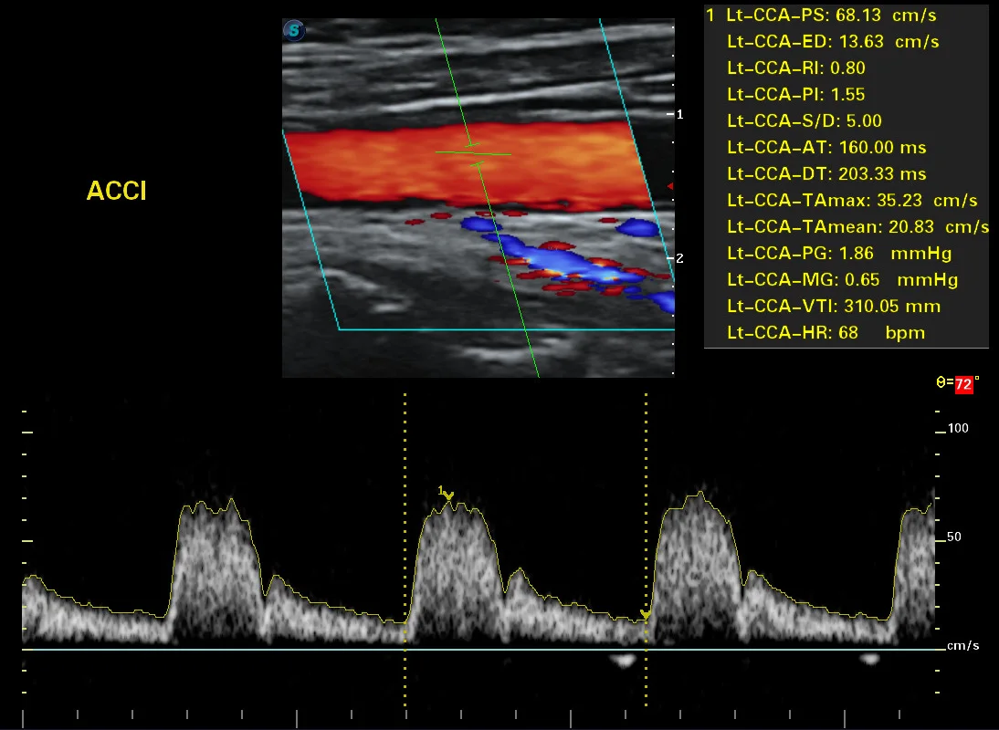 Doppler color y espectral de la arteria carótida común izquierda con medición de velocidades · imagen clínica anonimizada