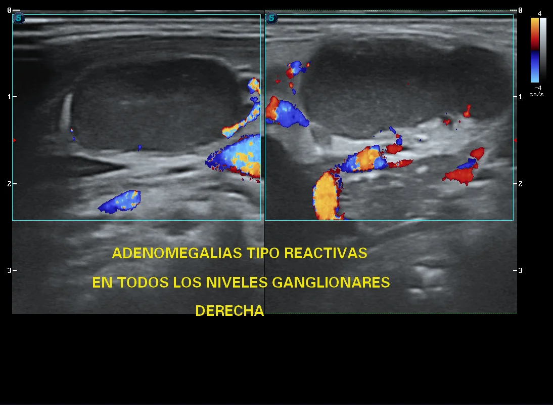 Ultrasonido Doppler de ganglios cervicales derechos rotulados como adenomegalias de tipo reactivo · imagen clínica anonimizada