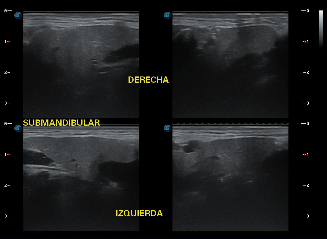 Ultrasonido comparativo de las glándulas submandibulares derecha e izquierda · imagen clínica anonimizada
