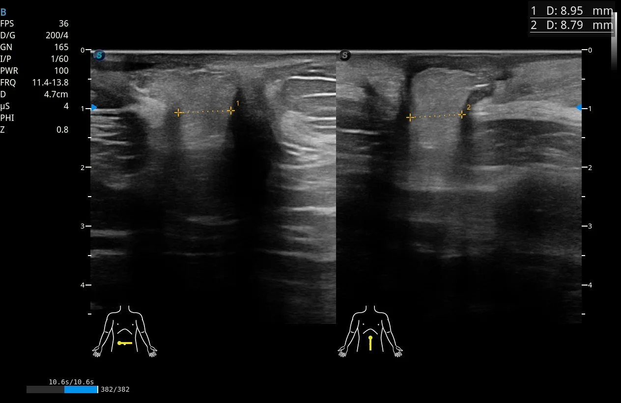 Ultrasonido de hernia umbilical en dos planos con mediciones de 8.95 y 8.79 mm · imagen clínica anonimizada