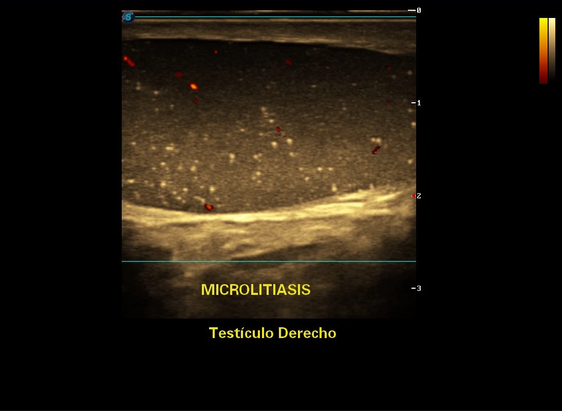 Microlitiasis testicular derecha con evaluación Doppler · imagen clínica anonimizada