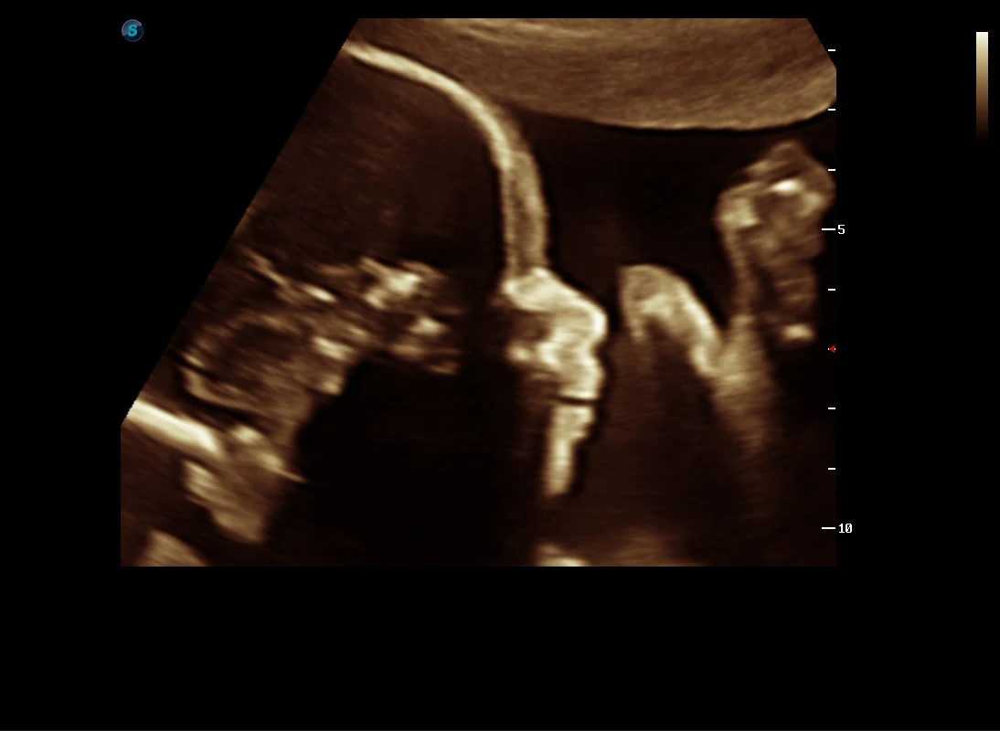 Perfil fetal a 26 semanas en ultrasonido obstétrico · imagen clínica anonimizada