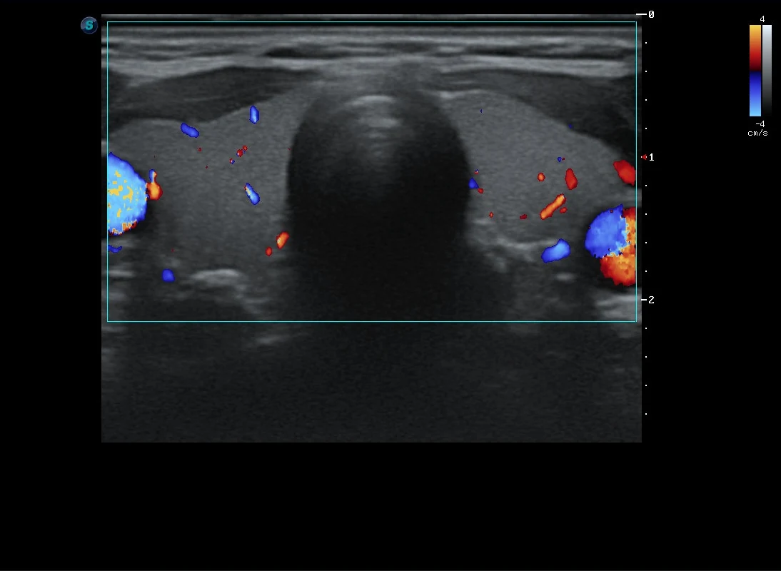 Ultrasonido pediátrico de tiroides con Doppler color · imagen clínica anonimizada