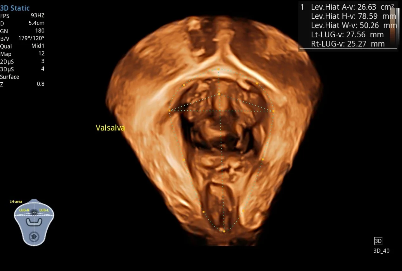 Reconstrucción 3D del piso pélvico durante maniobra de Valsalva con mediciones del hiato · imagen clínica anonimizada