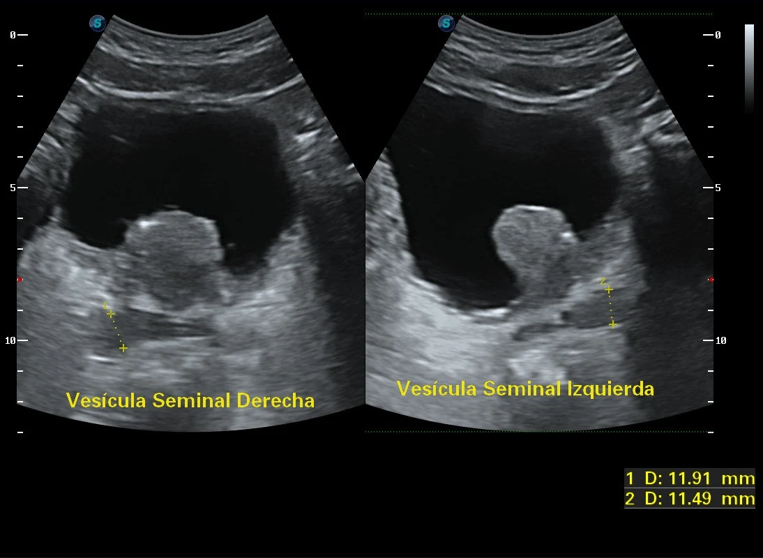 Ultrasonido transrectal de vesículas seminales bilaterales · imagen clínica anonimizada