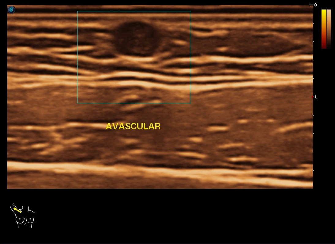 Quiste subdérmico superficial con evaluación Doppler · imagen clínica anonimizada