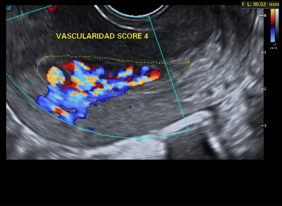 Restos ovulares con vascularidad Doppler score 4 delimitada · imagen clínica anonimizada