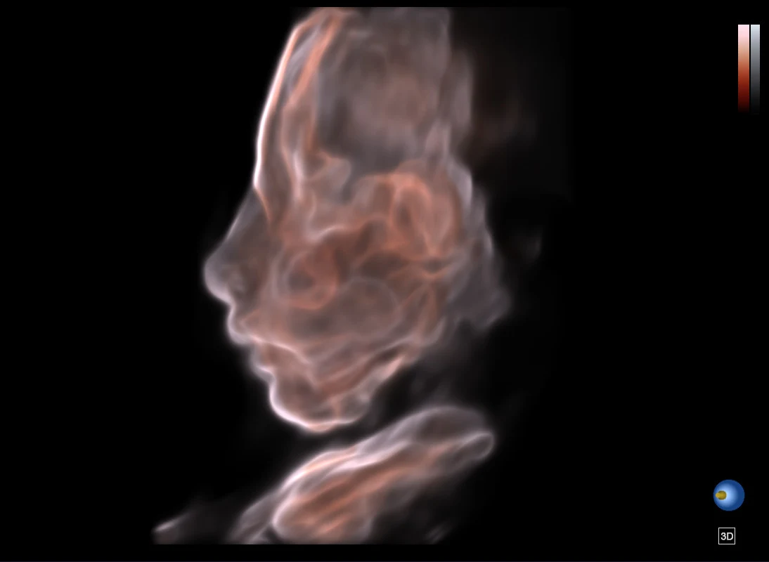 Perfil y rostro fetal en reconstrucción 3D · imagen clínica anonimizada