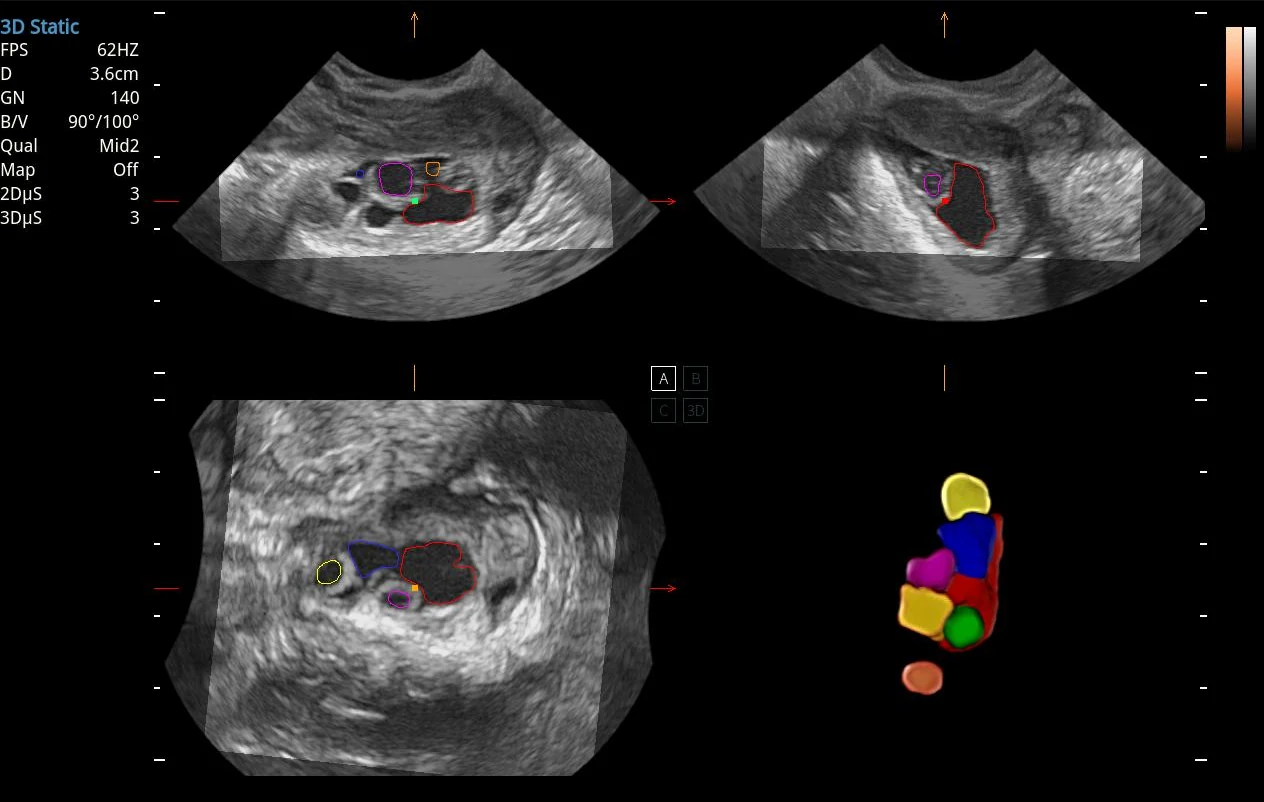 Conteo folicular 3D volumétrico con cortes tomográficos · imagen clínica anonimizada