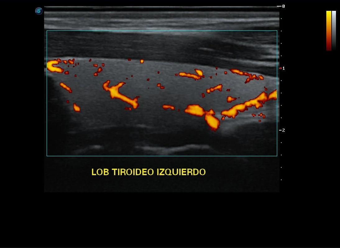 Ultrasonido de tiroides con Doppler power del lóbulo izquierdo · imagen clínica anonimizada
