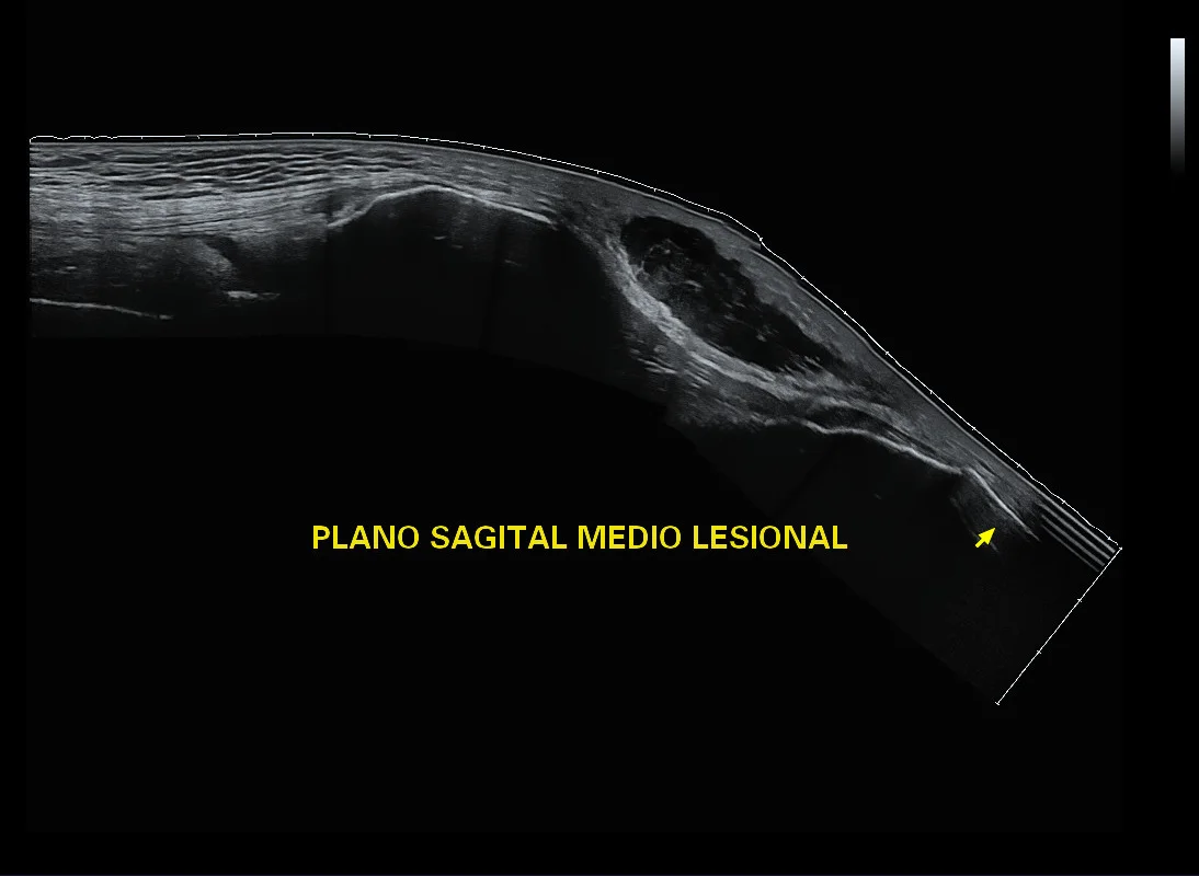 Ultrasonido musculoesquelético panorámico de rodilla en plano sagital medio · imagen clínica anonimizada