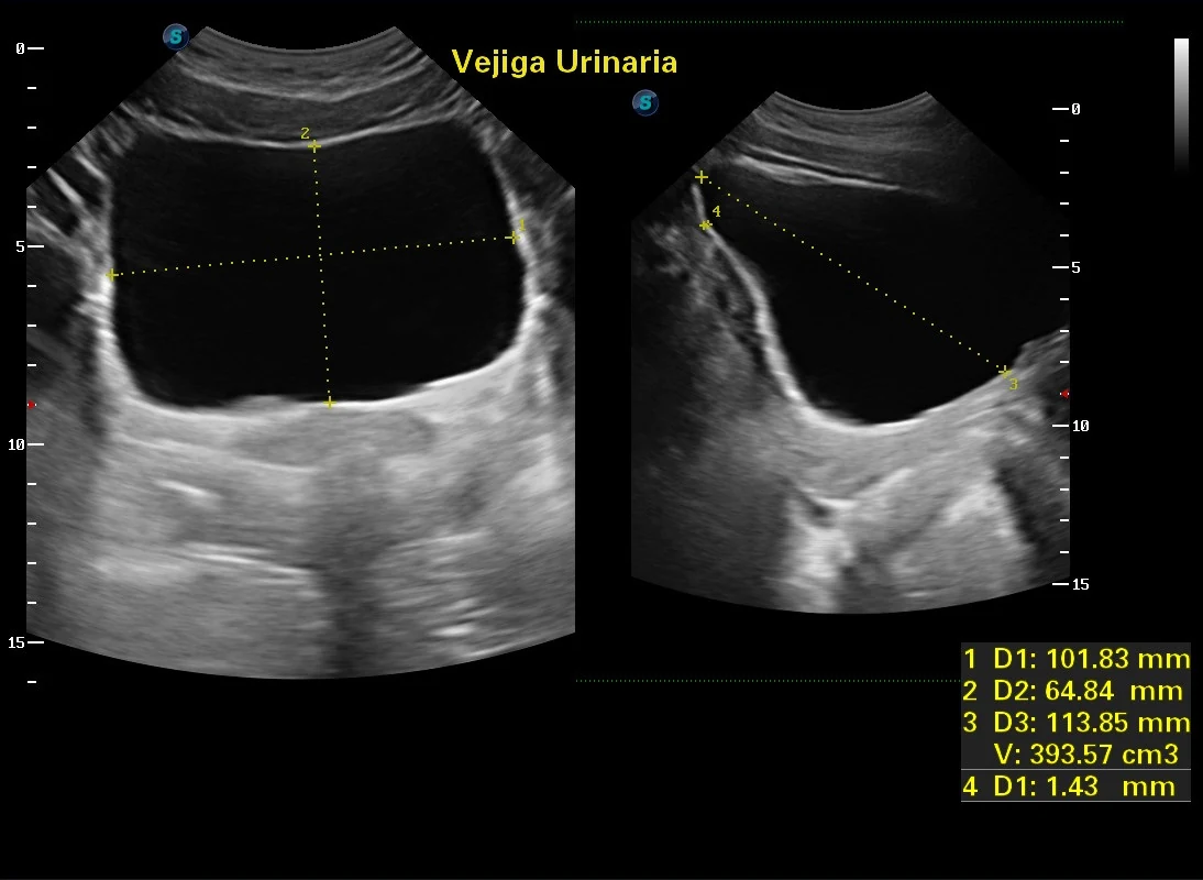 Ultrasonido vesical con medición de volumen y grosor de pared · imagen clínica anonimizada