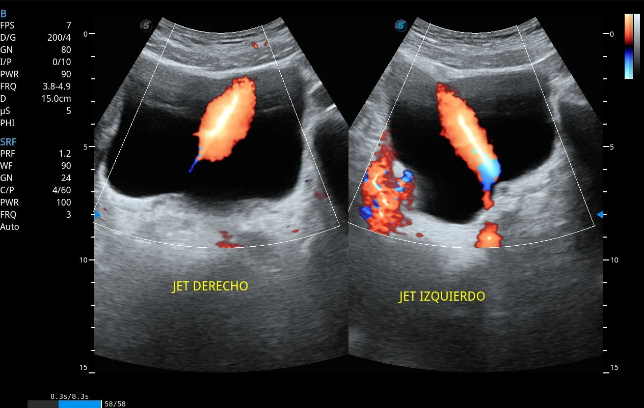 Doppler color de jets ureterales bilaterales hacia vejiga · imagen clínica anonimizada
